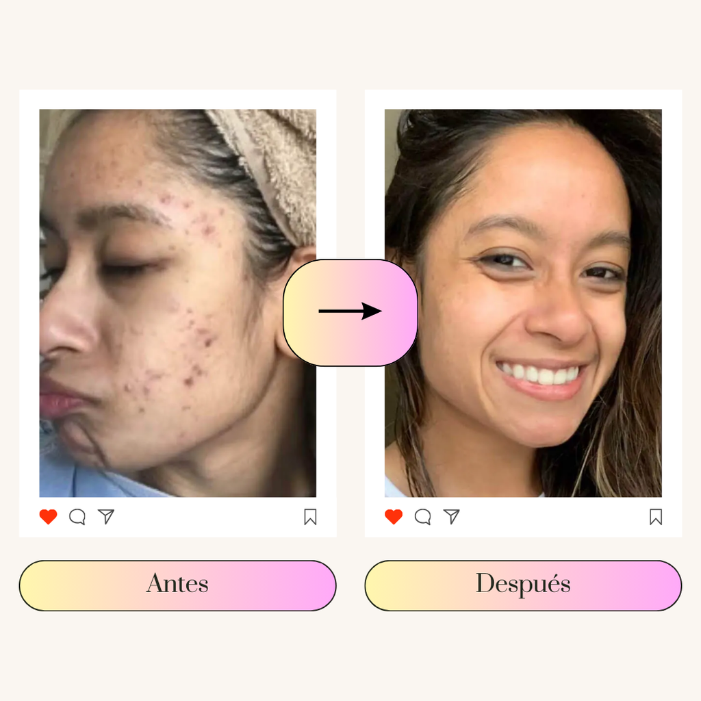 PMS Relief | Elimina el acné hormonal en 3 meses y repara la barrera cutánea