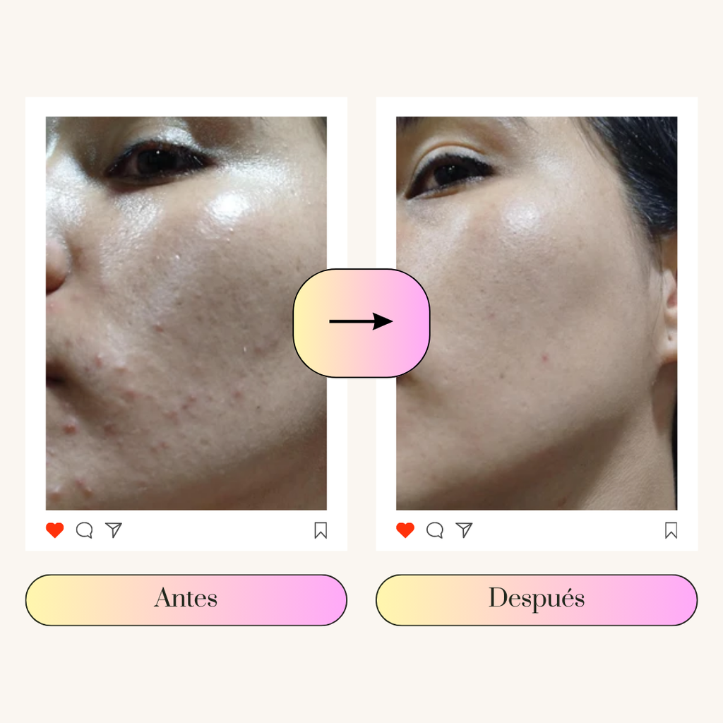 PMS Relief | Elimina el acné hormonal en 3 meses y repara la barrera cutánea
